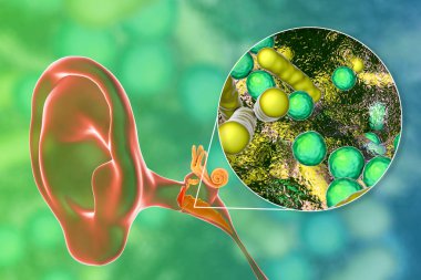 Otitis medyası, orta kulağın iltihaplı hastalığı, ve bakteriye yakından bakma, otitin nedensel faktörü, 3 boyutlu illüstrasyon