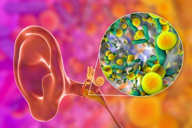 Otitis medyası, orta kulağın iltihaplı hastalığı, ve bakteriye yakından bakma, otitin nedensel faktörü, 3 boyutlu illüstrasyon