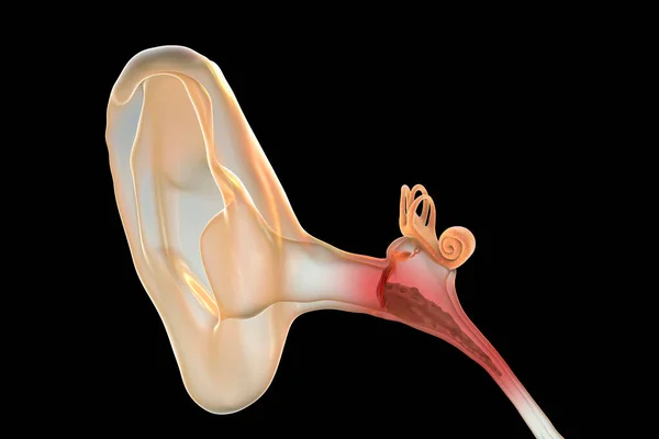 Otitis Media Inflamory Disease Middle Ear Illustration — 스톡 사진