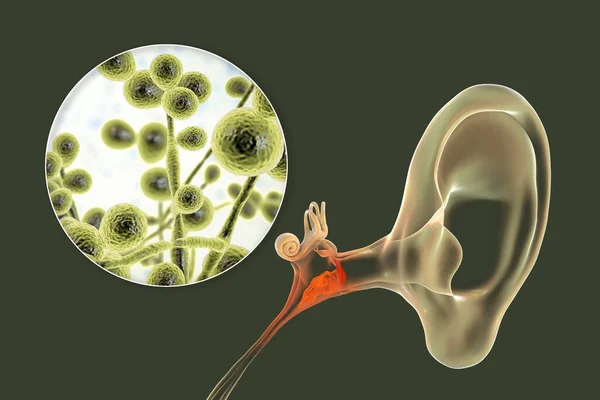 Przewlekłe Ropne Zapalenie Ucha Środkowego Wywołane Przez Grzyby Candida Choroba — Zdjęcie stockowe