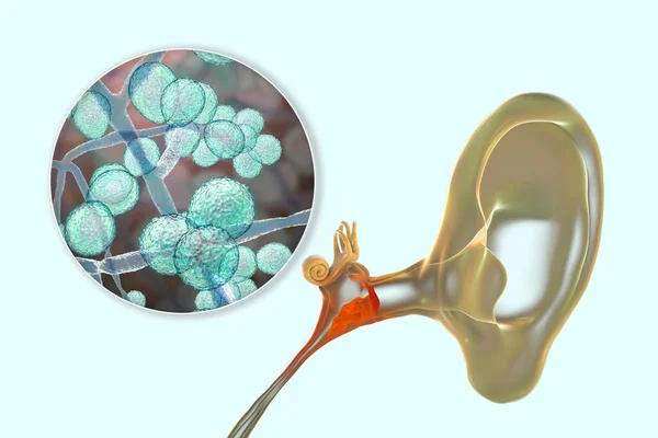 真菌性念珠菌引起的慢性化脓性中耳炎 中耳炎症 3D图例 — 图库照片