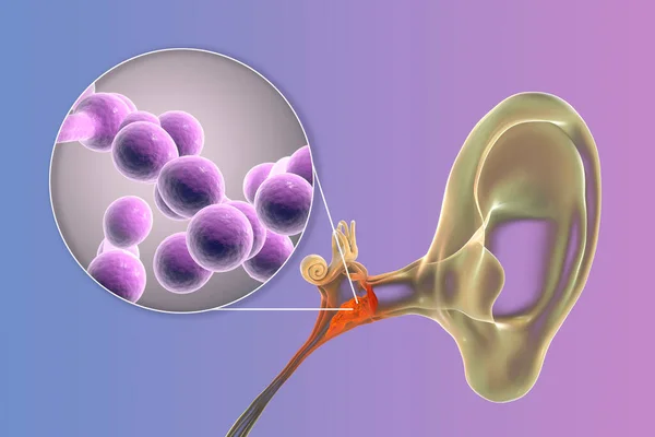 Przewlekłe Ropne Zapalenie Ucha Środkowego Wywołane Przez Grzyby Candida Choroba — Zdjęcie stockowe