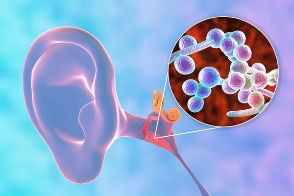真菌性念珠菌引起的慢性化脓性中耳炎 中耳炎症 3D图例 — 图库照片