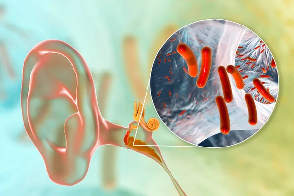 Otitis Media Una Enfermedad Inflamatoria Del Oído Medio Vista Cerca — Foto de Stock