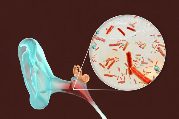 中耳炎症性中耳炎 细观细菌性中耳炎的病因 3D图解 — 图库照片