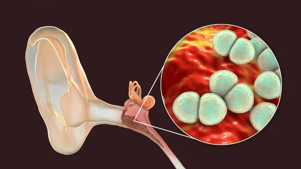 中耳炎の炎症性疾患であるストレプトコッカス肺炎によって引き起こされるOtitisメディア 3Dイラスト — ストック写真