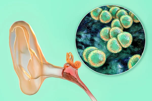 Средний Отит Вызванный Бактериями Streptococcus Pneumoniae Воспалительным Заболеванием Среднего Уха — стоковое фото