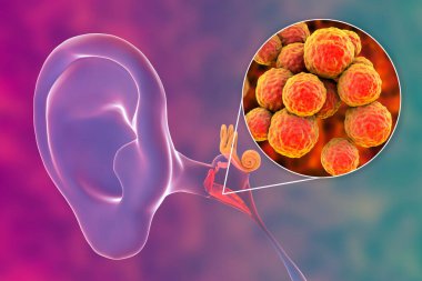 Orta kulağın iltihaplı bir hastalığı olan Staphylococcus aureus bakterisinden kaynaklanan ostitis medyası, 3 boyutlu illüstrasyon