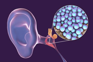 Orta kulağın iltihaplı bir hastalığı olan Staphylococcus aureus bakterisinden kaynaklanan ostitis medyası, 3 boyutlu illüstrasyon