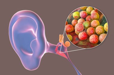 Orta kulağın iltihaplı bir hastalığı olan Staphylococcus aureus bakterisinden kaynaklanan ostitis medyası, 3 boyutlu illüstrasyon