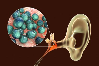 Orta kulağın iltihaplı bir hastalığı olan Staphylococcus aureus bakterisinden kaynaklanan ostitis medyası, 3 boyutlu illüstrasyon