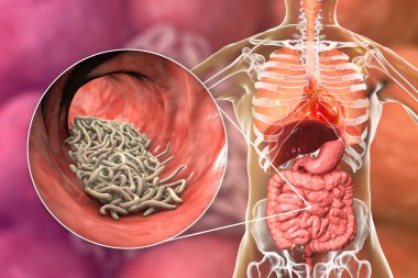 Parasitic worms in human intestine, 3D illustration. Ascaris lumbricoides and other round worms clipart