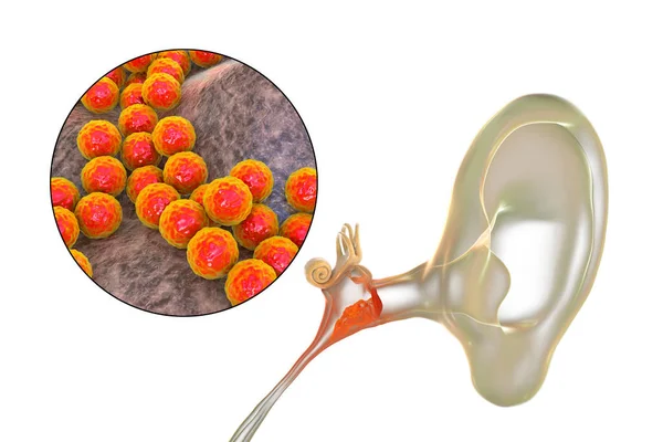 Staphylococcus Aureus 발생하는 Otitis Media 염증성 — 스톡 사진