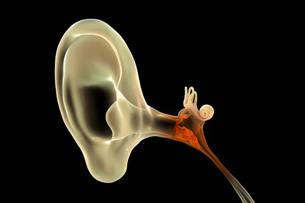 Zapalenie Ucha Środkowego Grupa Chorób Zapalnych Ucha Środkowego Ilustracja — Zdjęcie stockowe