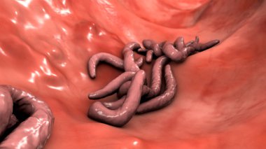 Bağırsak lümeninde parazit solucanlar, 3 boyutlu çizimler. Ascaris lumbrikoides, Enterobius vermicularis ve diğer yuvarlak solucanlar.