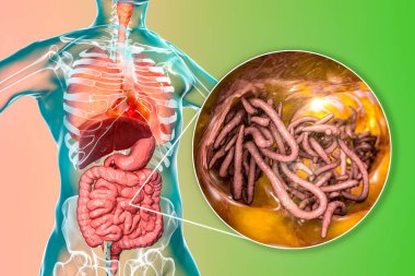 Parasitic worms in human small intestine, 3D illustration. Ascaris lumbricoides and other round worms clipart