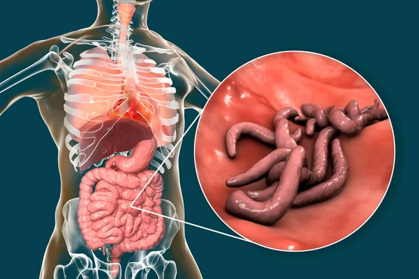 Gusanos Parásitos Intestino Delgado Humano Ilustración Ascaris Lumbricoides Otros Gusanos — Foto de Stock