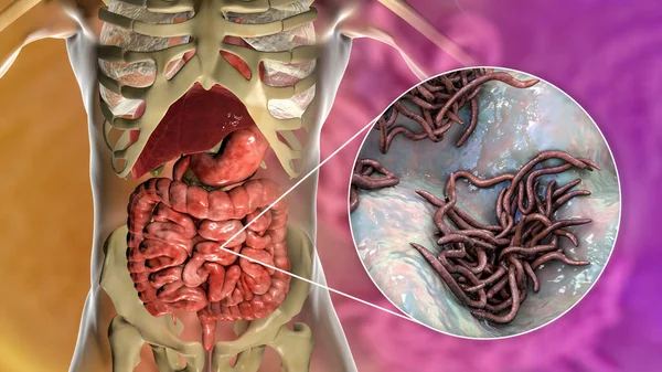 Parasitic worms in human small intestine, 3D illustration. Ascaris lumbricoides and other round worms