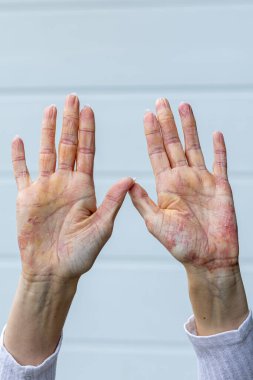 Hands show clear symptoms of eczema and psoriasis, with redness, dryness, and cracked skin. The image is taken in a well-lit outdoor space, emphasizing the condition.