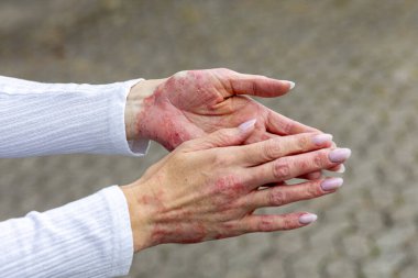 Hands show visible signs of eczema and psoriasis, with red patches and dry skin. The person stands outdoors on a patterned surface, emphasizing skin condition and struggle.