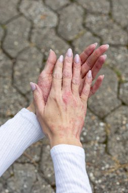 Two hands showing signs of eczema and psoriasis are clasped together on a stone path. The skin shows redness and dryness, while the backdrop includes natural elements.