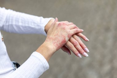 Hands show signs of eczema and psoriasis with red patches and inflammation. Natural light highlights the severity of skin condition in a casual outdoor setting.