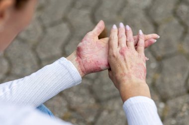 A person sits outdoors, examining their hands affected by eczema and psoriasis. The skin shows visible redness and irritation, highlighting the conditions. The setting is peaceful and natural.