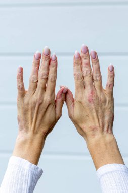 Hands with visible signs of eczema and psoriasis are raised, showing red patches and flaky skin. The fingers are elegantly positioned, highlighting the skin conditions.