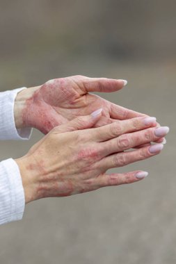 Red patches and dry skin are visible on the hands, indicating eczema and psoriasis. This scene captures a person gently rubbing their hands together outdoors in natural light.
