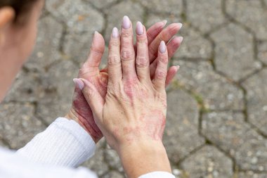 A person examines their hands showing signs of eczema and psoriasis. The skin appears red and irritated, with visible dryness and cracking. This scene takes place outdoors on a stone path.