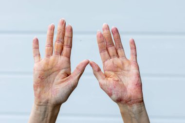 Two hands are raised, displaying visible symptoms of eczema and psoriasis, with dry patches and irritation on the skin. Natural light highlights the details of the conditions.