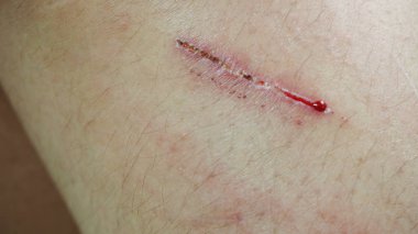 kadın diz grev kırıcılar ile yara