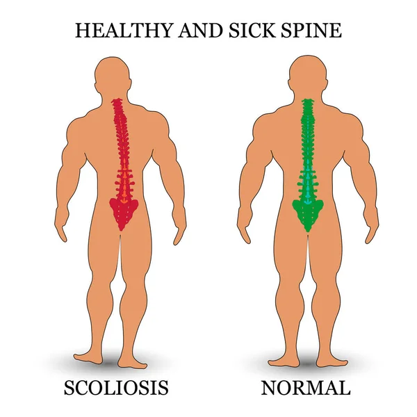 Colonna Vertebrale Sana Malata Scoliosi Condizioni Normali Poster Formazione Medica — Vettoriale Stock