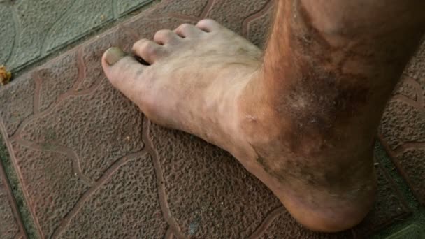 Doença Pele Humana Pessoa Que Afetado Por Doença Dermatológica Pele — Vídeo de Stock