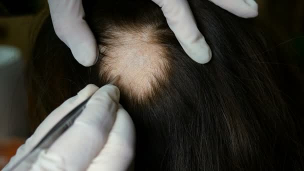 女性の脱毛 医師や美容師は 検査を行い 手順を行い 髪のない皮膚上の女性の頭 たぶん これは脱毛症 地衣類 トリクロホープシア ミクロスピアです — ストック動画