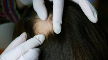 Kadın saç dökülmesi. Doktor ya da kozmetolojist muayene yapar, prosedürleri yapar, cilt üzerinde kadın başı olan hiçbir saç yoktur. Belki de bu alopesi areata, liken, trichopetia, mikrospori. Close