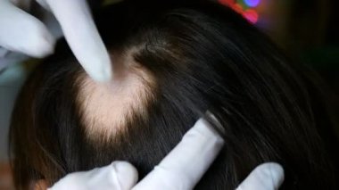 Kadın saç dökülmesi. Doktor ya da kozmetolojist muayene yapar, prosedürleri yapar, cilt üzerinde kadın başı olan hiçbir saç yoktur. Belki de bu alopesi areata, liken, trichopetia, mikrospori. Close