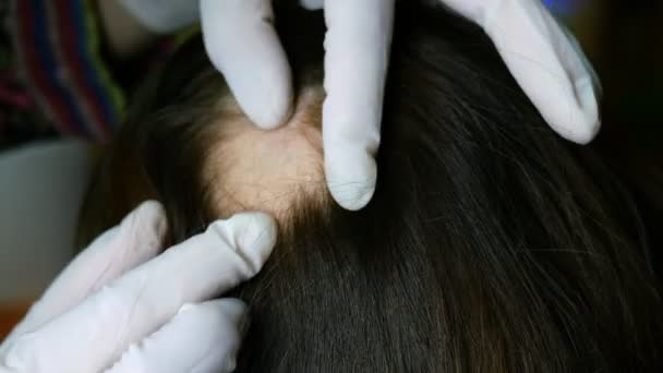 Mulher Perda Cabelo Doutor Cosmetologist Faz Inspeção Faz Procedimentos Cabeça — Vídeo de Stock
