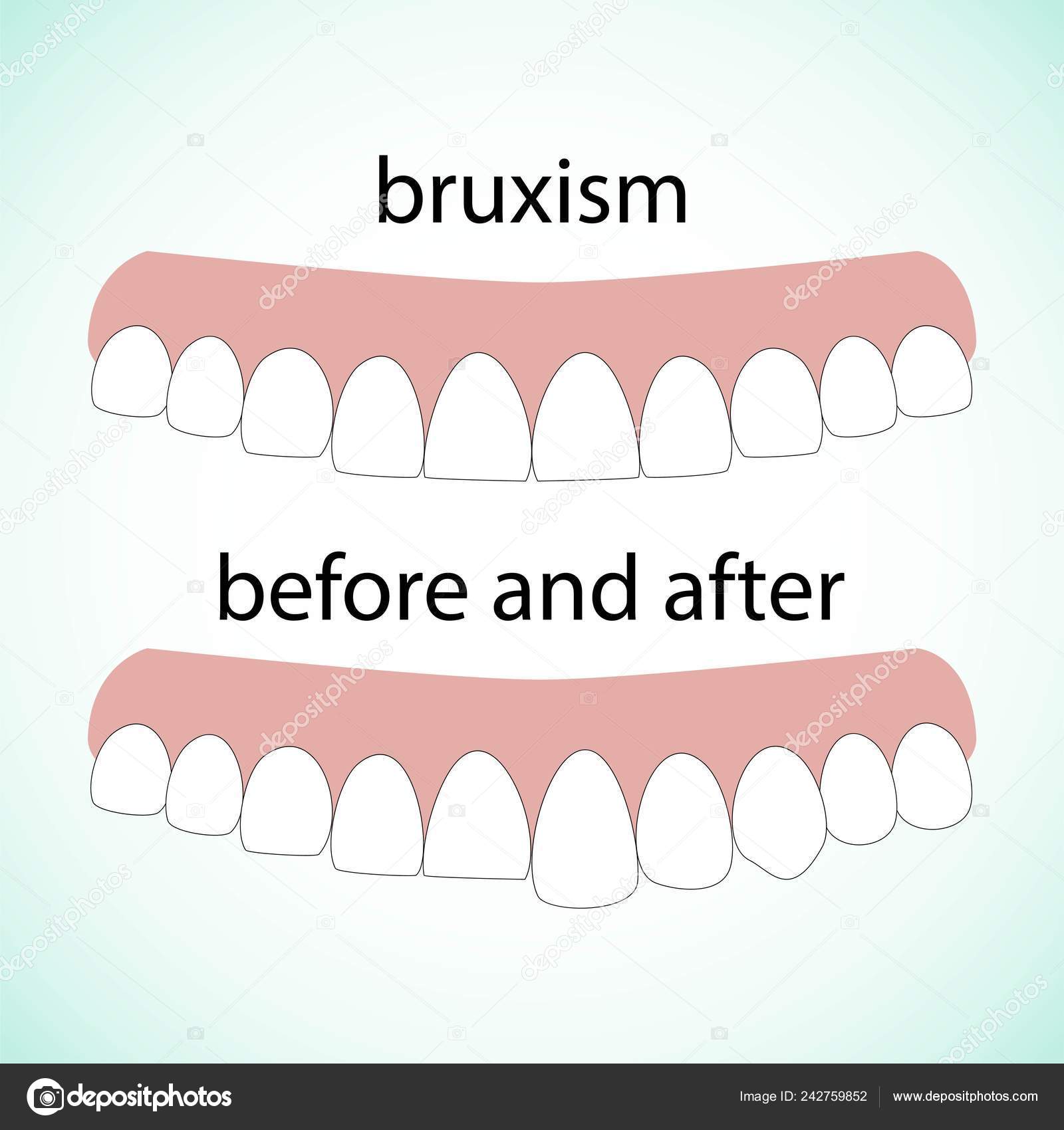 Layout Attrition Bruxism Teeth Illustration Vector Erased Teeth Restoration Stock Vector Image by ©Graffiti21 #242759852