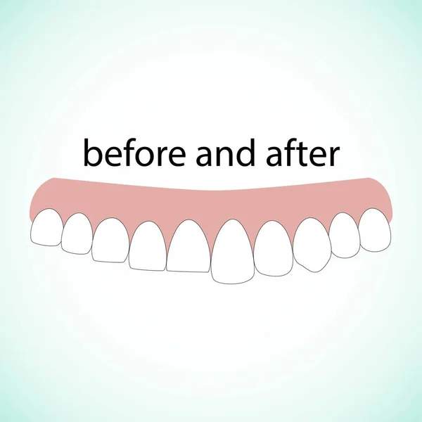 Dental Restoration Illustration Vector Blue Background Dental Concept — Stock Vector