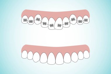 Ortodontik tedavi aşamaları vektör çizim üzerinde diş diş teli. Diş önce ve sonra diş telleri üzerinde. Arka planda düz stil