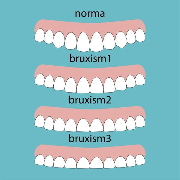 Tipos Borrado Dientes Diseño Desgaste Bruxismo Dientes Ilustración Vector Dientes — Vector de stock