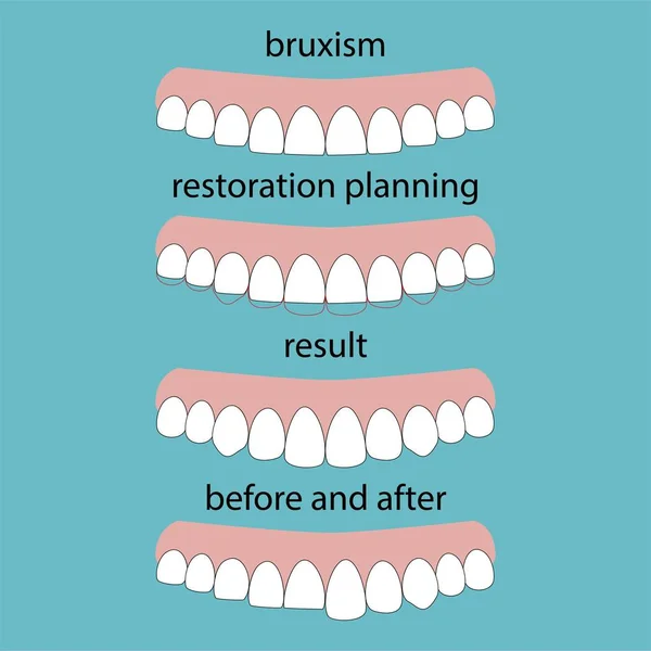 Layout Atrito Bruxismo Dentes Ilustração Vetor Dentes Apagados Restauração Dentes —  Vetores de Stock