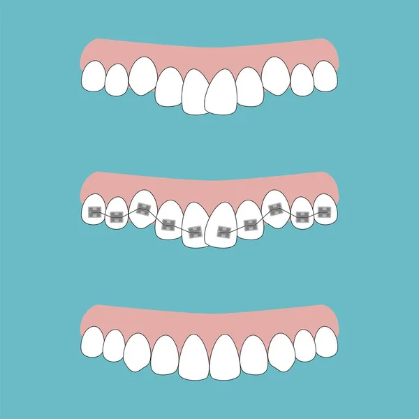 Vectorillustratie Van Stadia Van Orthodontische Behandeling Tussen Accolades Tanden Tanden — Stockvector