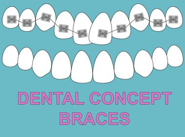 Afiş üst diş telleri diş illüstrasyon vektör mavi zemin üzerine. Diş kavramı.