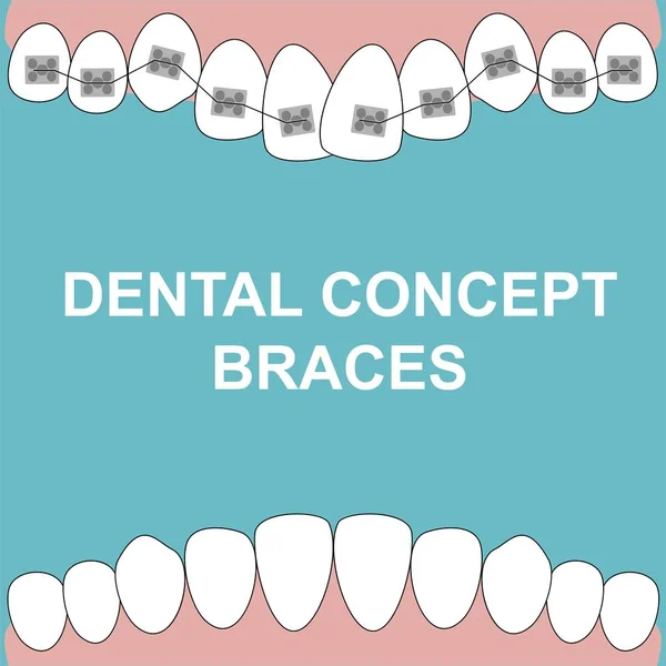 Вектор зубов верхних брекетов на синем фоне. Стоматологическая концепция . — стоковый вектор