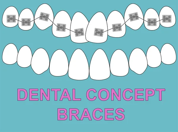 Вектор зубов верхних брекетов на синем фоне. Стоматологическая концепция . — стоковый вектор