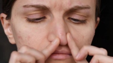 Düzgün olmayan cilt ile güzel kız yüzünde kırmızı akne haları