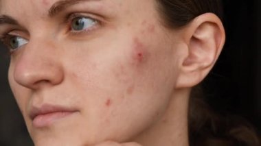 Düzgün olmayan cilt ile güzel kız yüzünde kırmızı akne haları