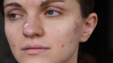 Yüzünde düzgün olmayan cilt smear kırmızı sivilce ile güzel kız